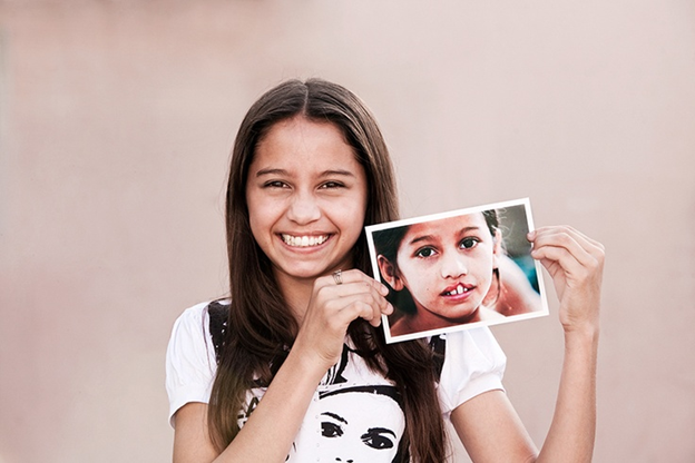 operation smile before and after